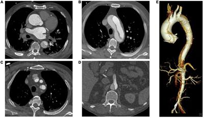 Impact of shift work on surgical outcomes at different times in patients with acute type A aortic dissection: A retrospective cohort study